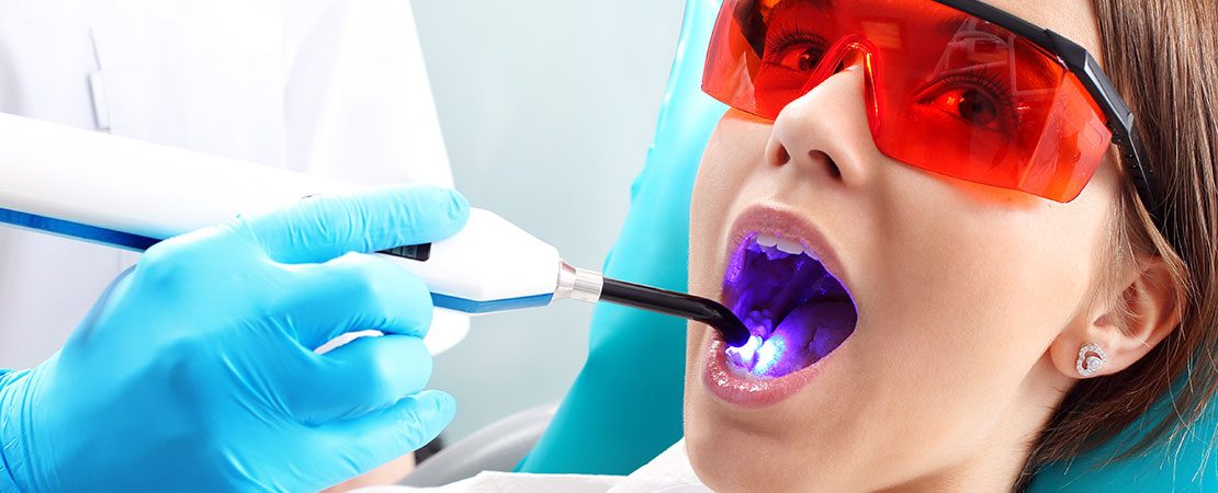 Tooth Bonding: How Long Does It Last?